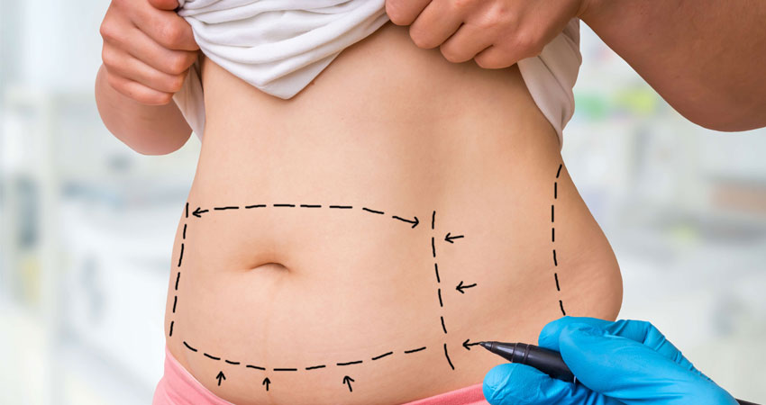 abdominoplasty-service