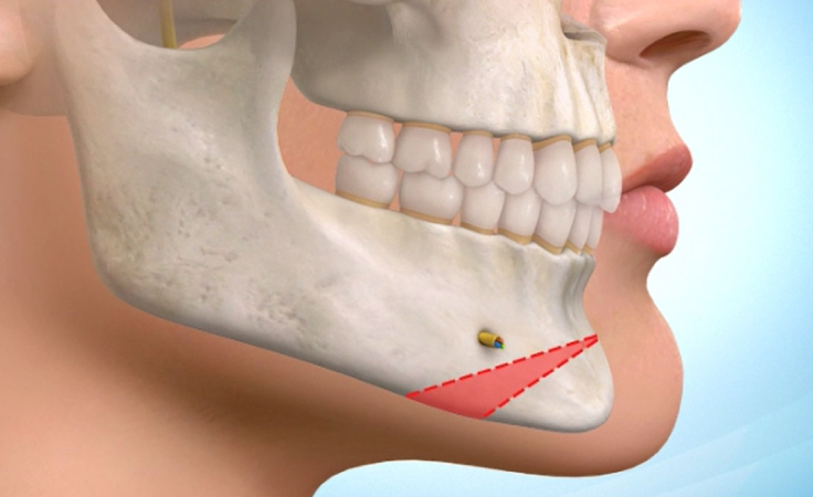 breast-augmentation-service